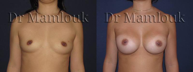 Augmentation mammaire par pose de prothèses rondes de 300 gr à profil modéré par voie aréolaire avec la technique de Dual Plan.