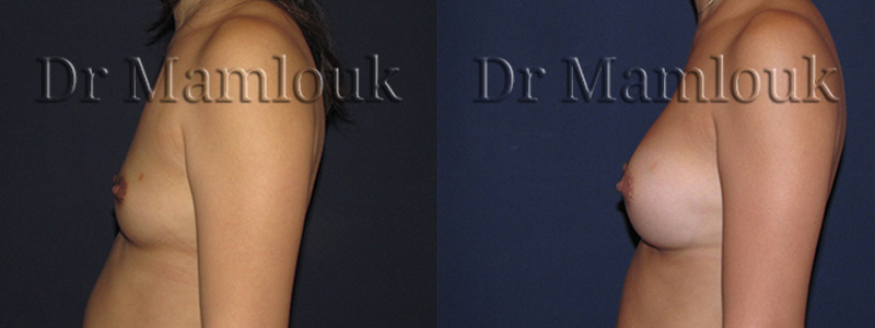 Augmentation mammaire par pose de prothèses rondes de 300 gr à profil modéré par voie aréolaire avec la technique de Dual Plan.