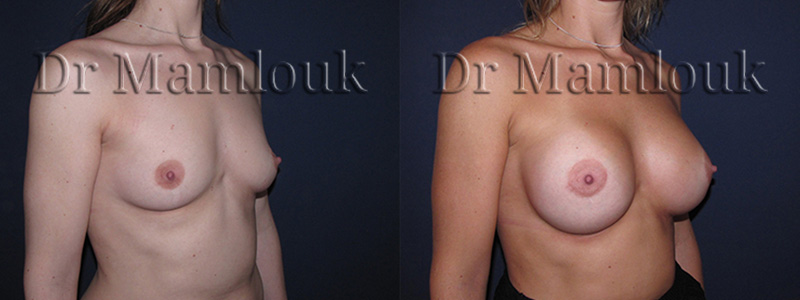 Augmentation mammaire par voie aréolaire, prothèses de 350 gr en position rétro-musculaire en utilisant la technique de Dual Plan.