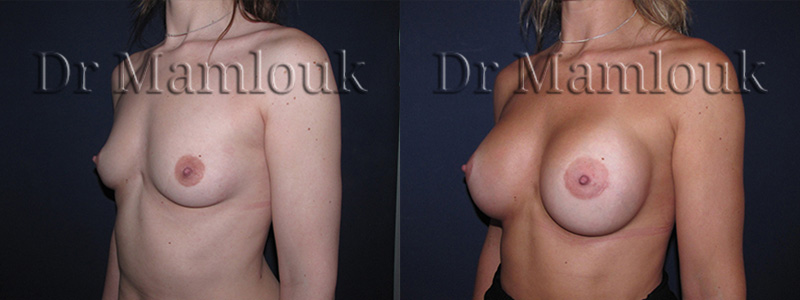 Augmentation mammaire par voie aréolaire, prothèses de 350 gr en position rétro-musculaire en utilisant la technique de Dual Plan.