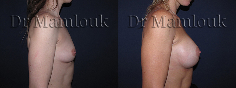 Augmentation mammaire par voie aréolaire, prothèses de 350 gr en position rétro-musculaire en utilisant la technique de Dual Plan.