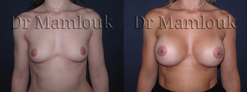 Augmentation mammaire par voie aréolaire, prothèses de 350 gr en position rétro-musculaire en utilisant la technique de Dual Plan.