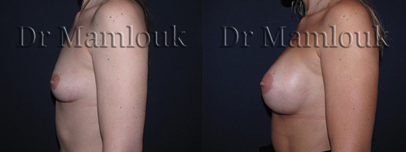 Augmentation mammaire par voie aréolaire, prothèses de 350 gr en position rétro-musculaire en utilisant la technique de Dual Plan.