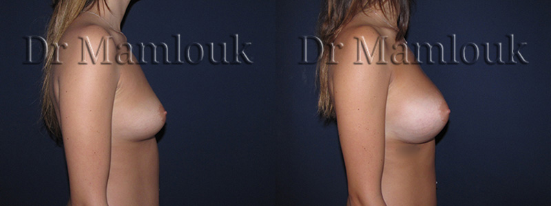 Pose de prothèses de prothèses rondes de 350 cc à profil modéré par voie sous mammaire, en position pré-musculaire.