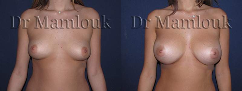 Pose de prothèses de prothèses rondes de 350 cc à profil modéré par voie sous mammaire, en position pré-musculaire.