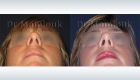 Rhinoplastie pour correction de nez hyperprojeté et bosse réalisé par le Docteur Mamlouk - Vue de dessous