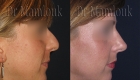 Rhinoplastie pour correction de nez hyperprojeté et bosse réalisé par le Docteur Mamlouk - profil droit