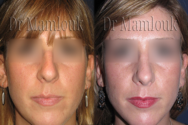 Rhinoplastie pour correction de nez hyperprojeté et bosse réalisé par le Docteur Mamlouk - Vue de face