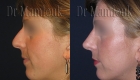 Rhinoplastie pour correction de nez hyperprojeté et bosse réalisé par le Docteur Mamlouk - Profil gauche