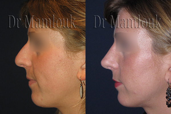 Rhinoplastie pour correction de nez hyperprojeté et bosse réalisé par le Docteur Mamlouk - Profil gauche